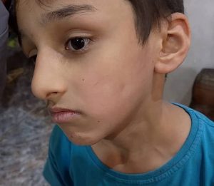 ويقول “العبدلله” إن الحادثة تركت أثرًا نفسيًا كبيرًا على ابنه، الذي أصبح يرفض العودة إلى المدرسة بشكلٍ قاطع، مشيرًا إلى أن أربعة طلاب آخرين تعرّضوا للصفع ذاته من قِبل المعلمة، دون أن تتخذ الإدارة أي إجراء بحقها حتى الآن.